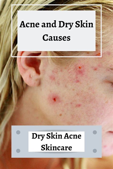 What Causes Dry Acne Prone Skin Yellowzap Dry Acne Prone Skin Dry