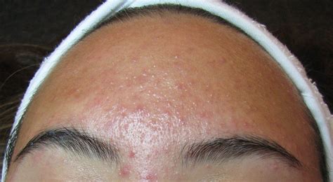 It Looks Like Acne But Its Folliculitis Acne Treatment Best Acne