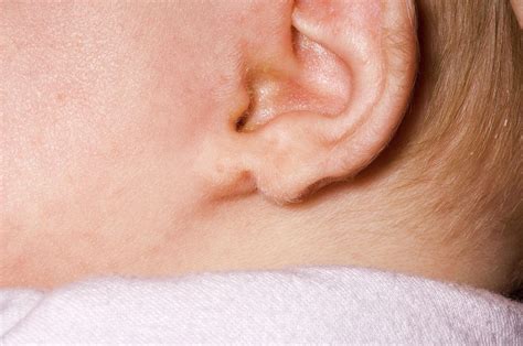 Congenital Split Ear Lobe Photograph By Dr P Marazziscience Photo Library