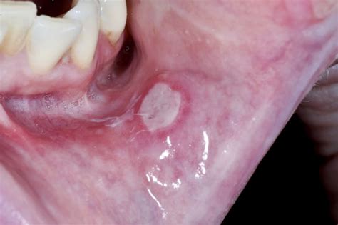 Abscess Under Roof Of Mouth 12300 About Roof