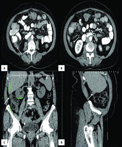 Axial Image Of Abdominal Ct With Iv And Oral Contrast Material