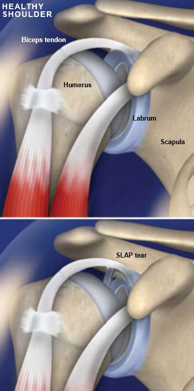 Slap Tear Central Coast Orthopedic Medical Group