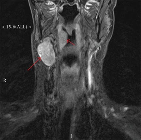 Mri Of The Neck Showing An Enlarged Lymph Node Long Ar Open I
