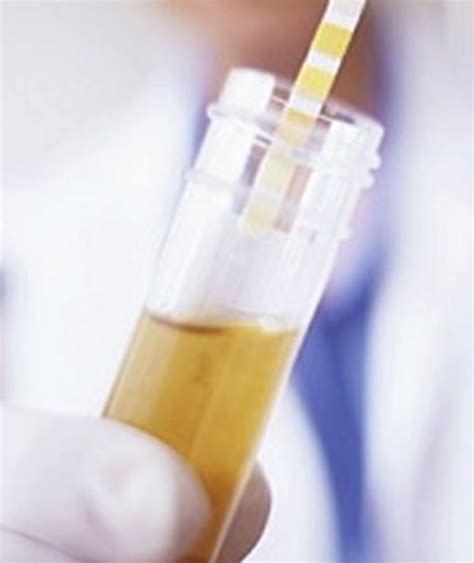 Cloudy Urine During Pregnancy Symptoms Treatment And Causes Hubpages