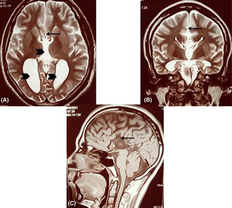 T2‐weighted Mri Images Of The Brain A Axial View B Coronal View C