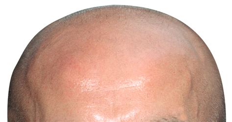 Early Balding Symptoms For Prostate Cancer Bald At Age Of 20 Links To