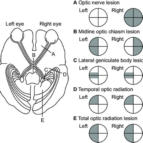 Various Types Of Visual Impairment Due To Damage To Areas Of The Optic