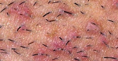 Razor Bumps Are Also Known As Pseudofolliculitis Barbae Technically