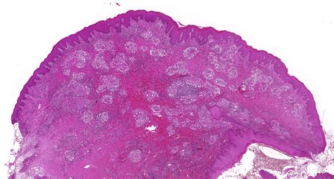 Polyps And Polypoid Lesions Of The Anus Diagnostic Histopathology My