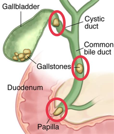Dah Operate Gallbladder Masalah Tak Jugak Selesaigallstones Di Bile