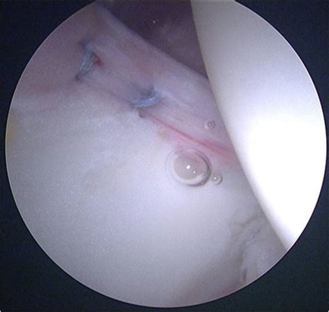 Hip Arthroscopy For Treatment Of An Acetabular Labral Tear In A Female