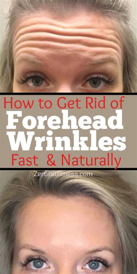 It's imperative to replenish hydration and moisture both internally and externally to eliminate dry skin and smooth forehead wrinkles. How to Get Rid of Forehead Wrinkles Fast- 10 Home Remedies ...