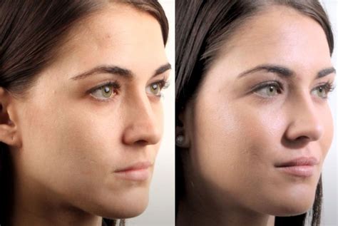 Nefertiti Lift Is A Non Surgical Lower Face Lift That Can Achieve