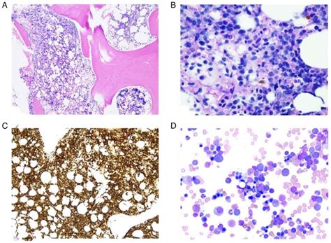 B‑cell Lymphoma‑associated Hemophagocytic Lymphohistiocytosis A Case