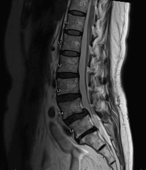 Degenerative Spondylolisthesis Spine Orthobullets Hot Sex Picture