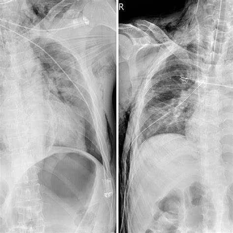 Chest Radiographs A Intraoperative Chest Radiograph Showing