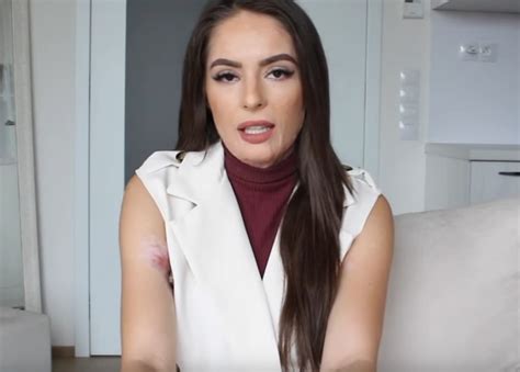 VIDEO Popálená Týnuš Třešničková promluvila o léčbě a ukázala drsnou fotku z nemocnice Co