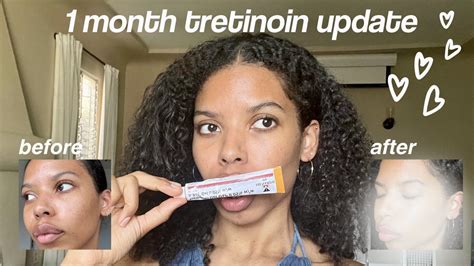 1 Month Tretinoin Update Before And After Transformation Honest