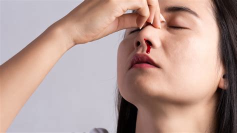 Epistaxis Nosebleed Symptoms Causes Treatment Preventions