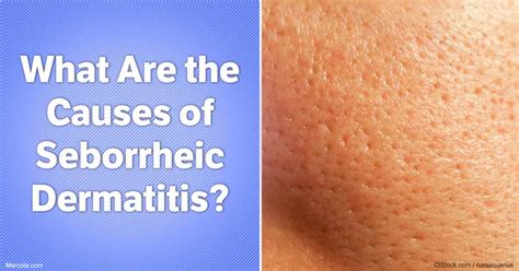 What Are The Causes Of Seborrheic Dermatitis