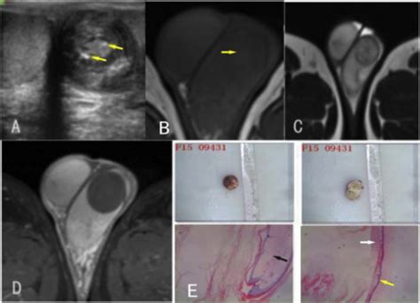 Imaging In Testicular Epidermoid Cysts Clinical Imaging