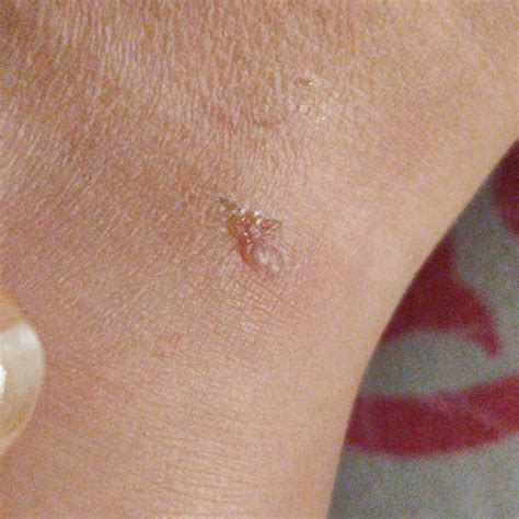 Asktheexpert My Baby Developed Blisters All Over Her Body Except Her