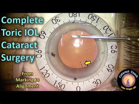 Torque Lenses For Cataract Surgery Doctorvisit