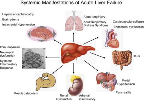 Liver Failure Causes Symptoms And Treatment Health Care Qsota