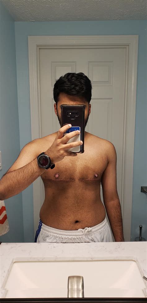 8 Weeks Post Op Top Surgery Any Scar Tips I Think They Are Stretching