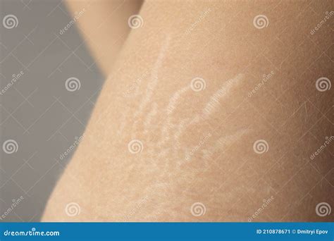Woman Showing Stretch Marks On Her Back Scars From Stretch Marks On The Back Stock Image