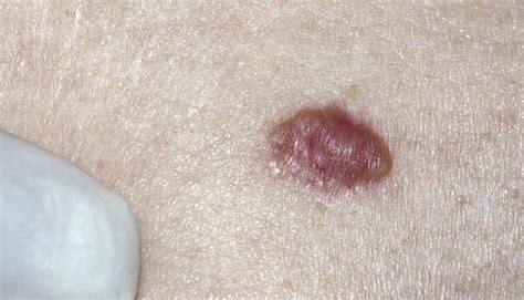Skin Cancer Spots On Arm