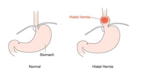 Upper Endoscopy Hiatal Hernia