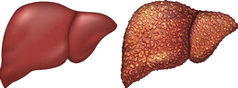 Cirrhosis of the liver is a disease of the liver, symptoms may present in a variety of ways, some of the most common are a lack of energy, tiredness, weight loss, loss of hunger, nausea and weakness. Cirrhosis of Liver - Noble Institute of Gastroenterology