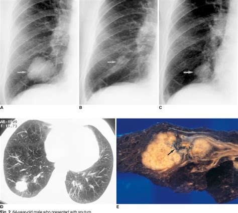 Figure 2 From Coexisting Bronchogenic Carcinoma And Pulmonary