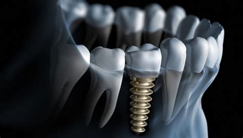 Dental Implant Procedure One Stage
