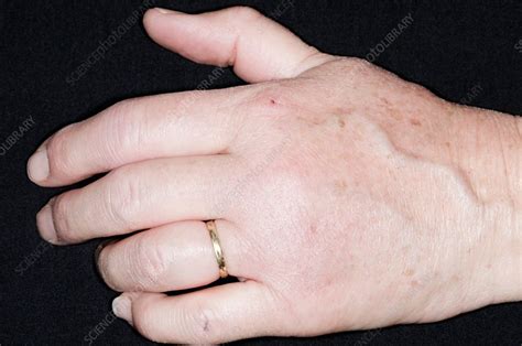 Swollen Hand In Rheumatoid Arthritis Stock Image C0168213