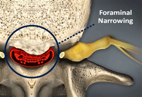 Foraminal Stenosis Causes Symptoms And Treatment Bonati