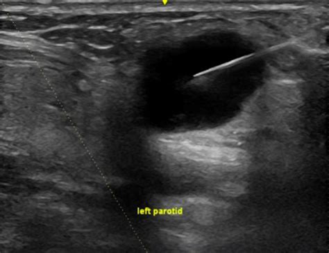 Pointofcare Ultrasound Scan As The Primary Modality For Evaluating Parotid Tumors Harb