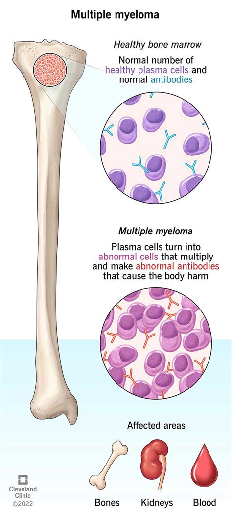 What Is End Stage Multiple Myeloma Like Loria Mccain