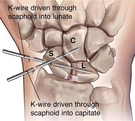 Scapholunate Ligament Repair With Capsulodesis Reinforcement Journal Of Hand Surgery