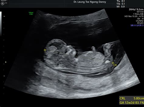 First Trimester Fetal Morphology Scan Hkog Info