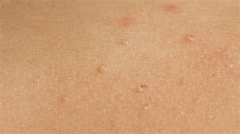 Molluscum Contagiosum Early Stages