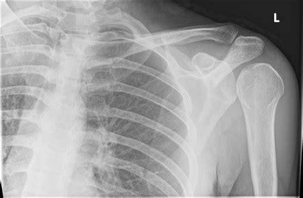 Posterior Shoulder Dislocation Radiology Reference Article Radiopaedia Org
