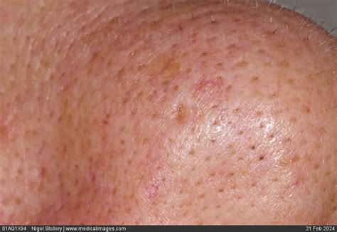 Stock Image Dermatology Sebaceous Hyperplasia Yellowish Soft Papules