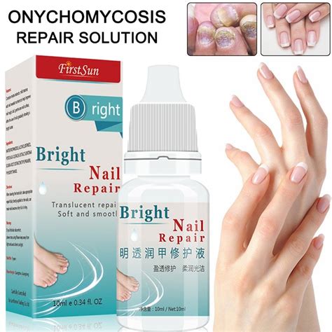 10ml Nail Fungal Treatment Anti Fungus Onychomycosis Removal Toenail