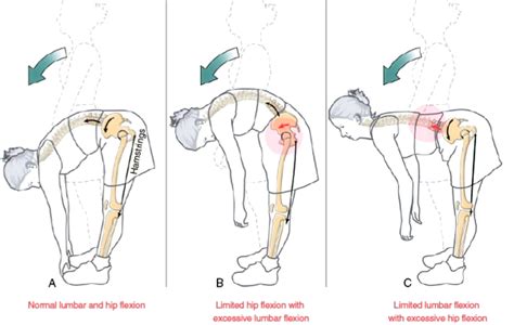 What Is Lumbopelvic Rhythm The Result Of Dissociation And Dysfunction