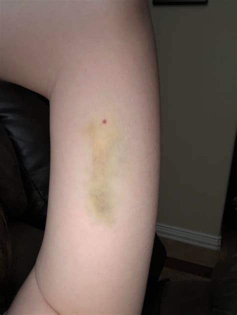 My Nexplanon Bruising 4 Days Later I Saw Some Photos Of Others