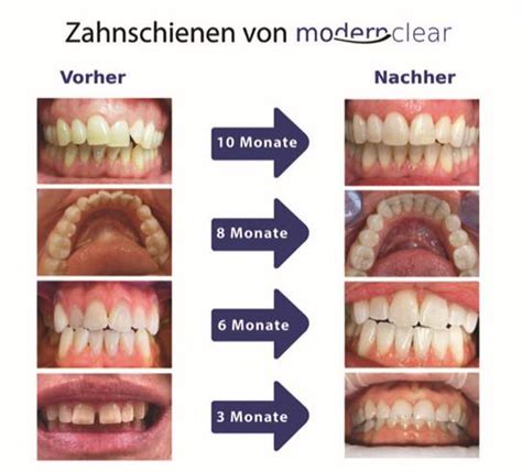 Aligner Therapie Focht And Focht Zahnarzt Konstanz