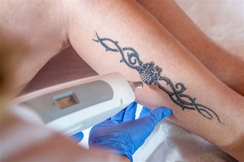 How To Remove A Tattoo Using Lasers Oro Gold School