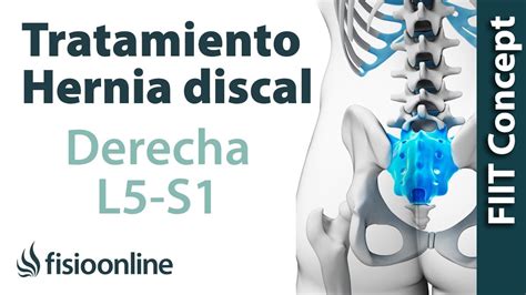 Tratamiento De La Hernia Discal L5 Y S1 Derecha O Quinta Lumbar Y Sacro